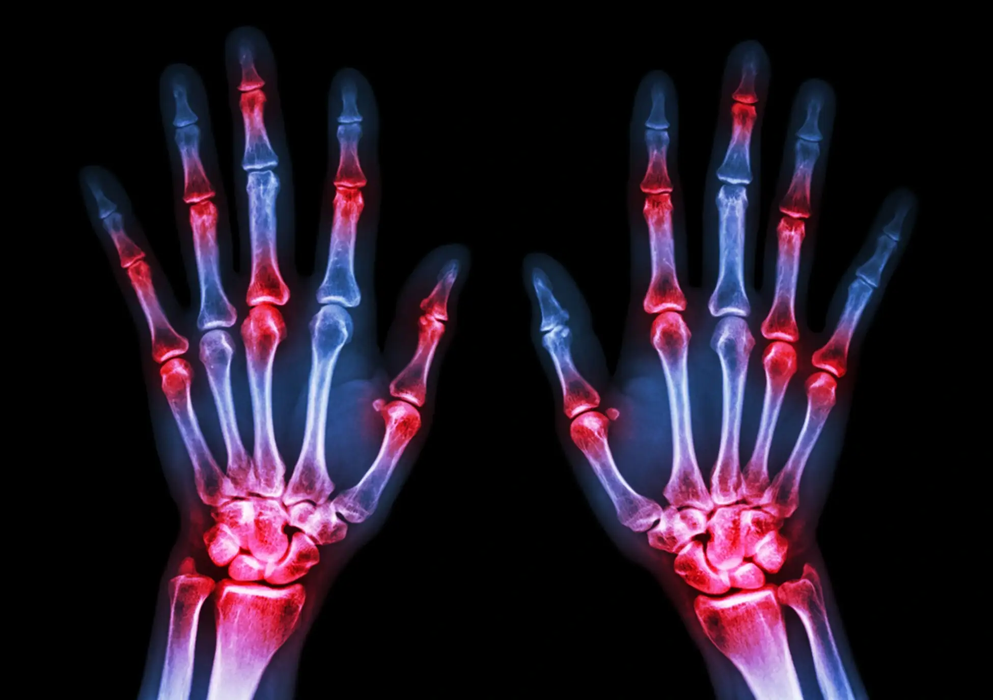 X-ray of hands showing inflamation of joints